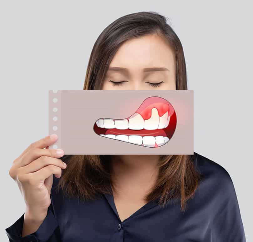 Periodontal Gum Disease